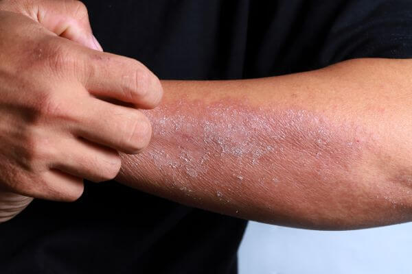 A person scratching their skin because of an eczema breakout