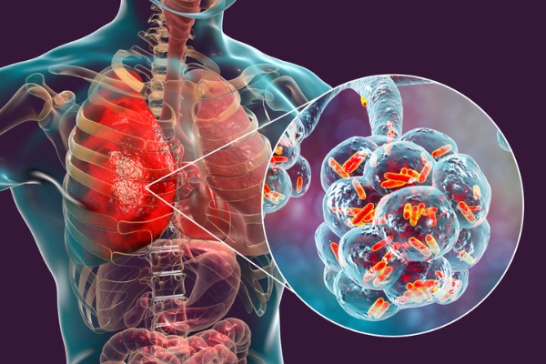 Graphic featuring an x-rayed chest with the lung containing Legionella bacteria highlighted